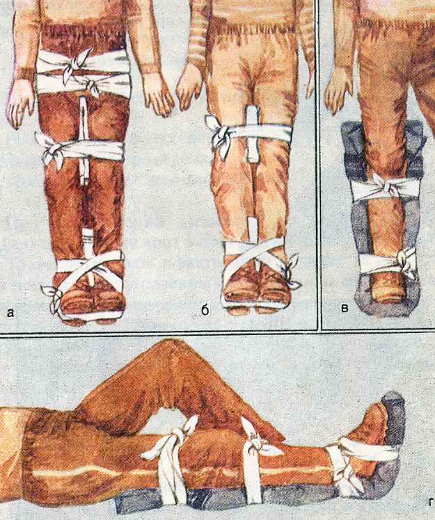 иммобилизация  при  переломах  костей  ног